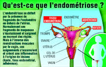 Endometriose