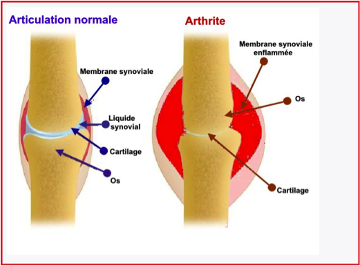 Arthrite